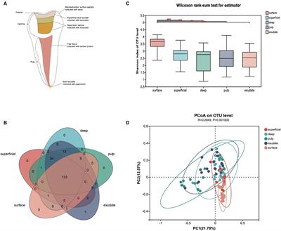 Bacterial dynamics in the progression of caries to apical periodontitis in primary teeth of children with severe early childhood caries